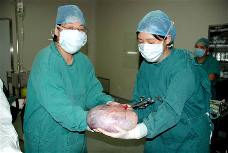 十分巨大的卵巢囊腫