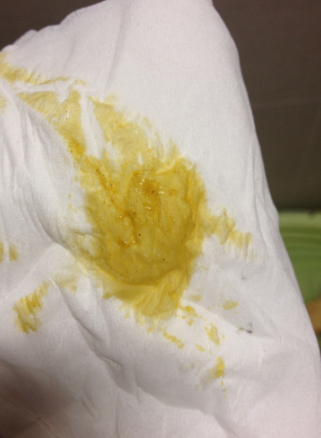 新生兒腹瀉大便