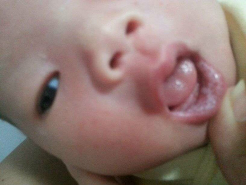 嬰兒皮膚念珠菌病