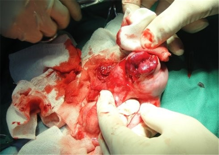 手術切除腸粘連