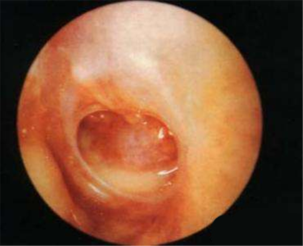 什麼是急性中耳炎