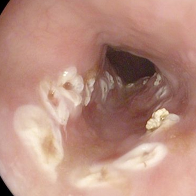 直腸癌晚期症狀 (6) 