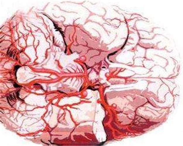 引起腦血管痙攣病因