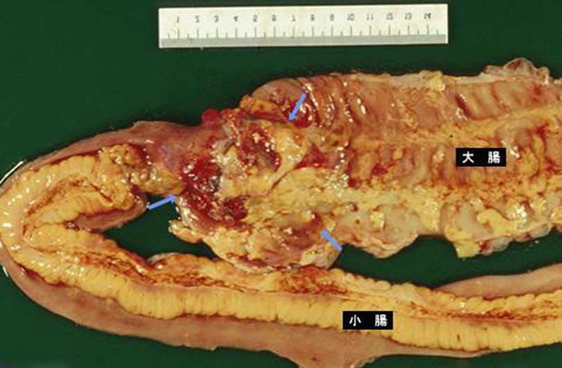 直腸腫瘤診斷證明