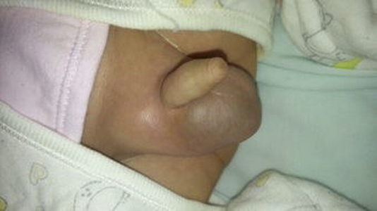 小兒鞘膜積液 (34) 