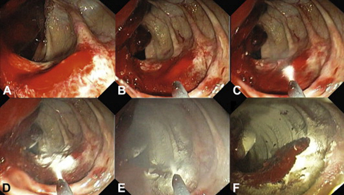 結腸癌症狀 (38) 