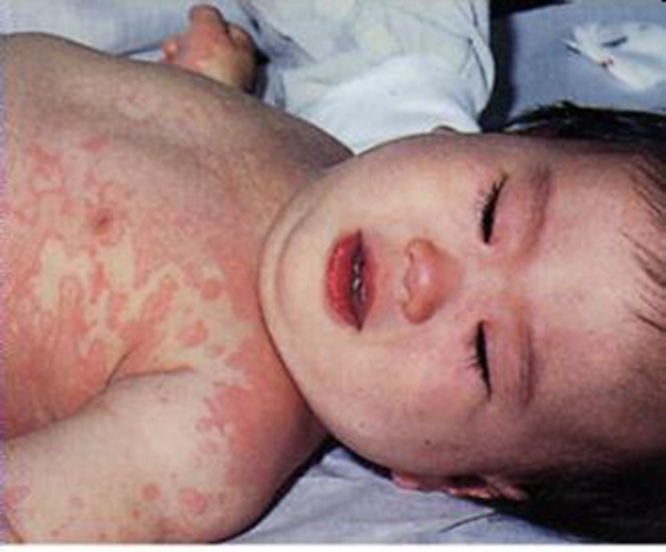 小孩子全身的淋巴結髮炎