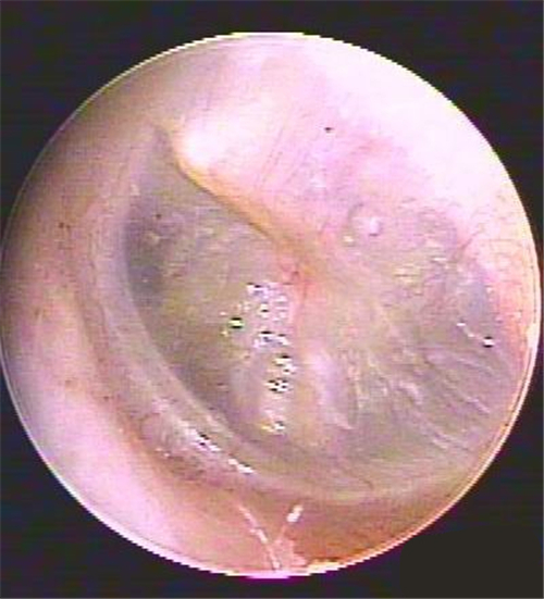 治好的鼓膜穿孔