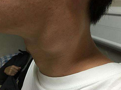 慢性淋巴結炎 (4) 