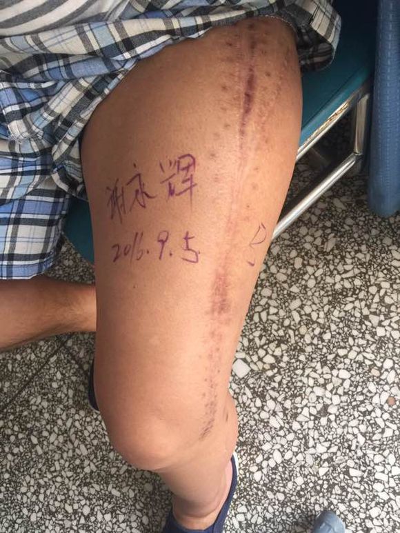 左腿骨肉瘤術後恢復