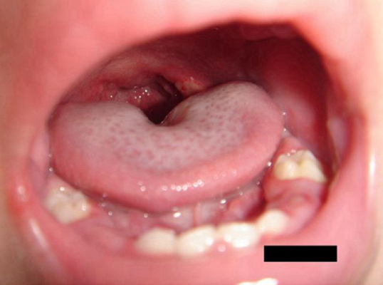 舌癌的初早期症狀