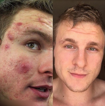 激素臉排毒症狀 (9) 