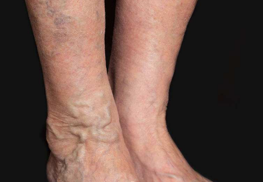 脈管炎早期症狀