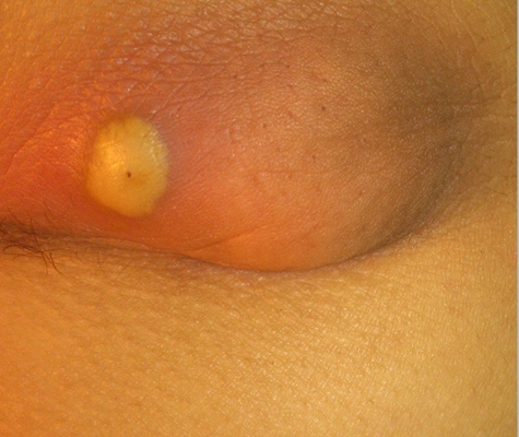 臀部癤子的症狀