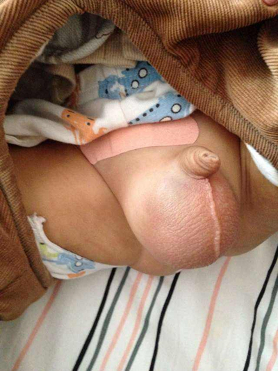 男寶寶疝氣的症狀