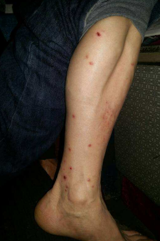 身體蟎蟲過敏症狀