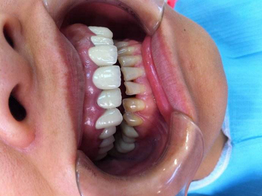 牙齦炎和牙周炎