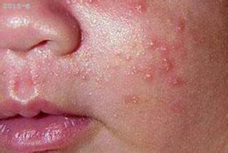 皮膚黃色瘤病症狀