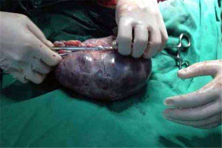 孕婦雙側巨大卵巢囊腫