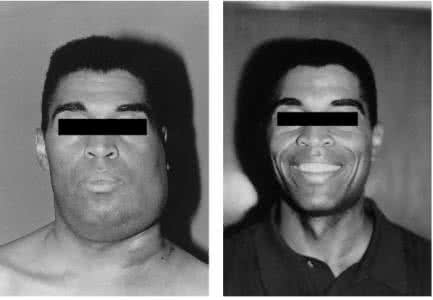 慢性淋巴結炎 (49) 