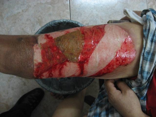 深二度燒傷 (49) 