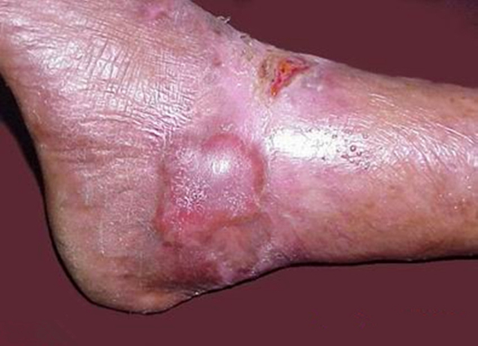 顯性營養不良大皰性皮膚病腳踝部