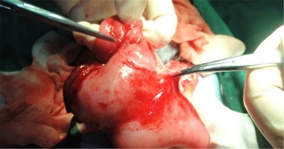 手術治療腸粘連