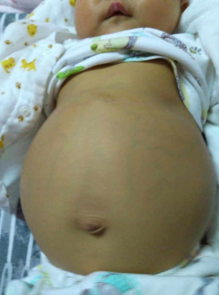 小孩為什麼患有腹水