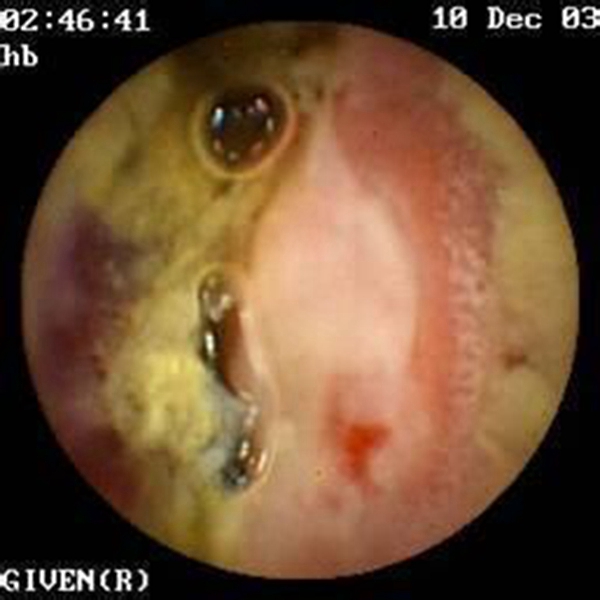 腫瘤腸腫瘤真實