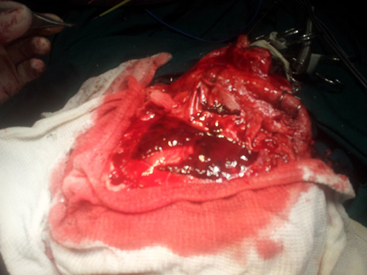 硬膜下血腫 (41) 