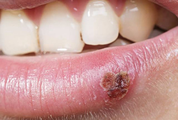 嘴上長皰疹 (52) 