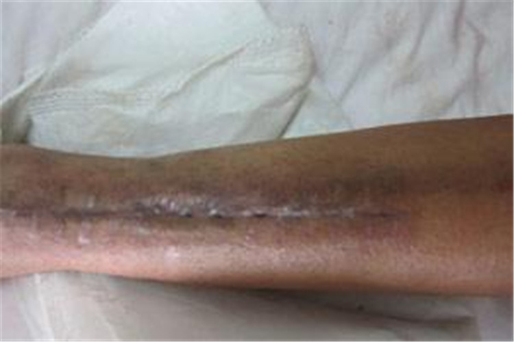 早期骨髓炎治療後