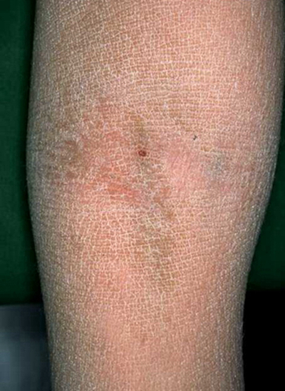 小腿皮膚像魚鱗 (51) 
