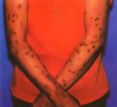 結節性癢疹 (42) 