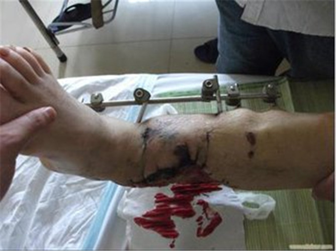 中期骨髓炎症狀