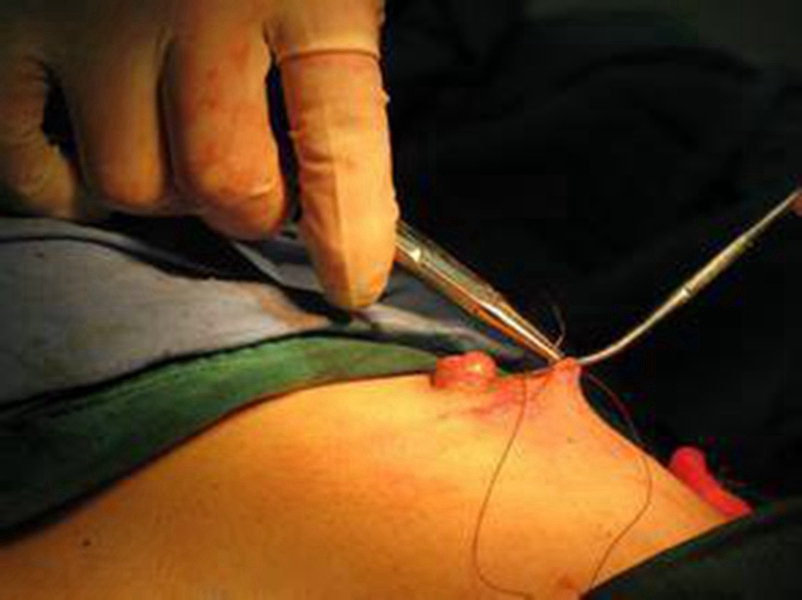 做過乳頭內陷手術