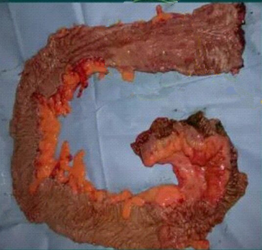 老人迴腸克羅恩病的