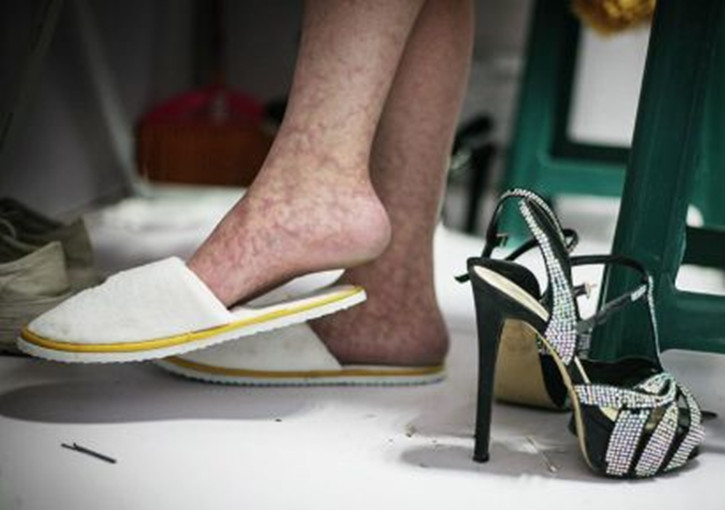 靜脈曲張怎麼引起 