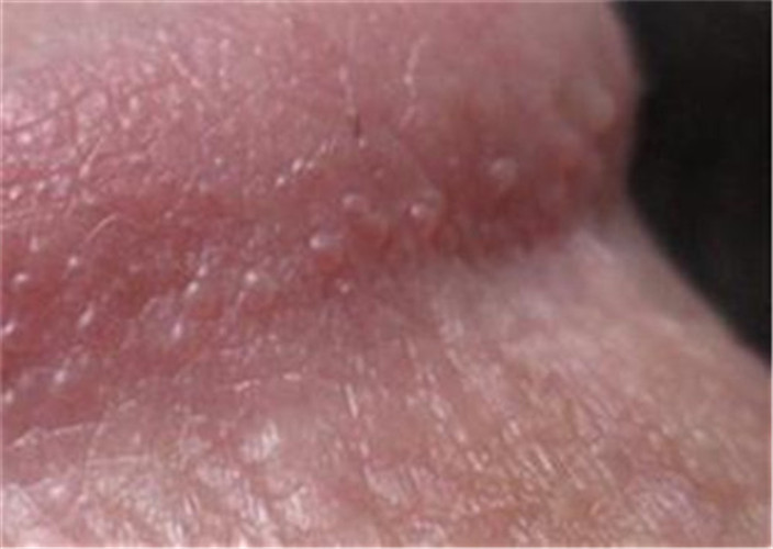 男性假性溼疣圖 