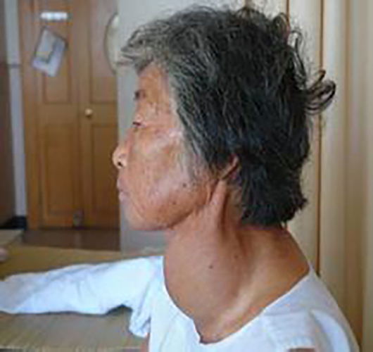 左側頸部甲狀腺腫大疼痛
