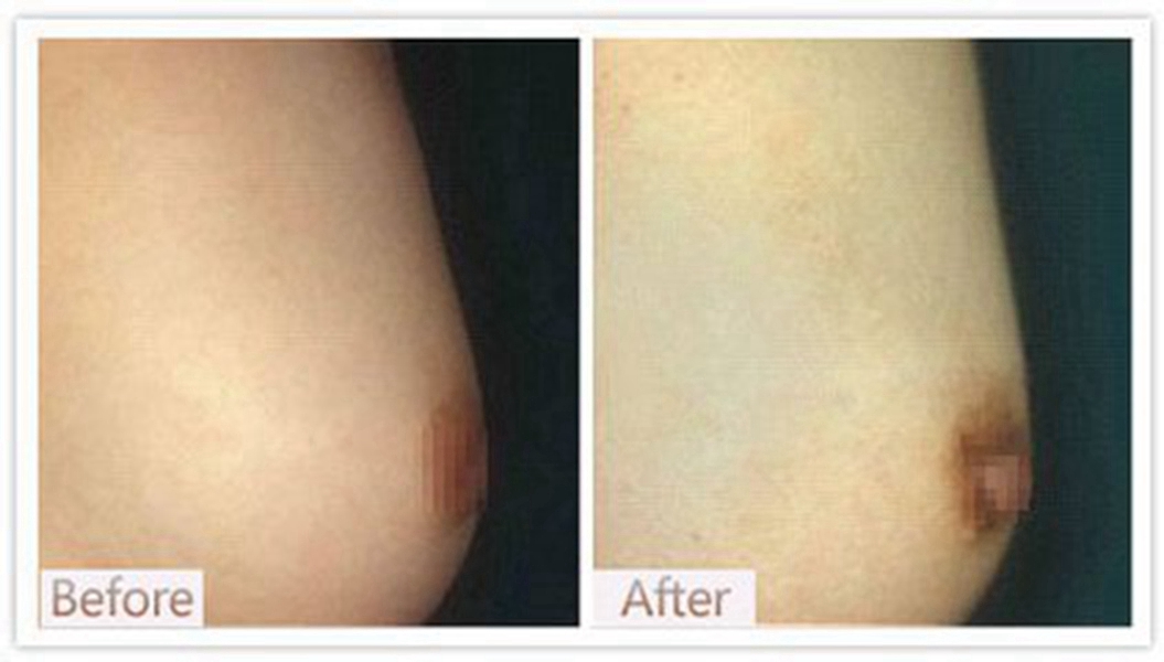 中度乳頭內陷矯正