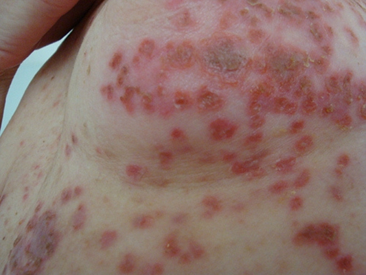 乳房溼疹 (8) 