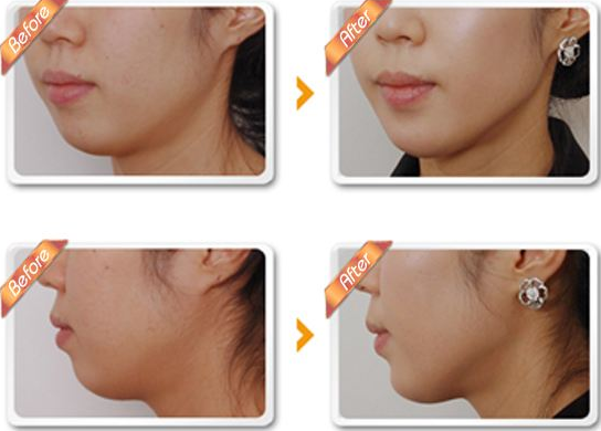 磨皮手術效果圖 (39) 