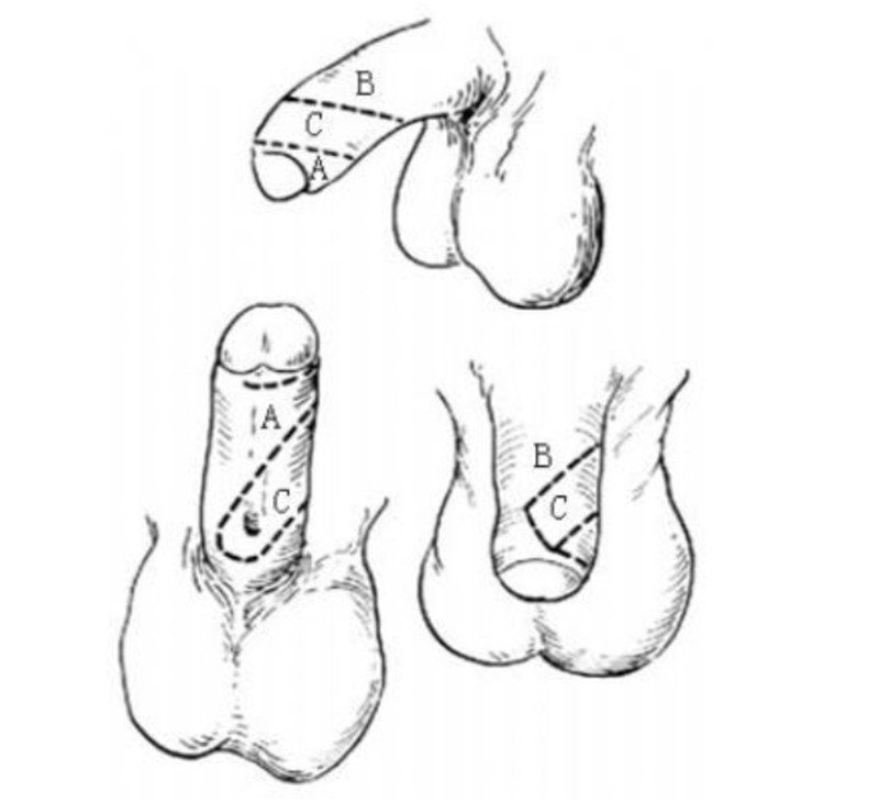 手術失敗導致尿道下裂