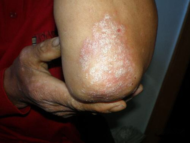 肘關節的皮膚結核病