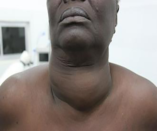 雙側甲狀腺腫大1度腫大