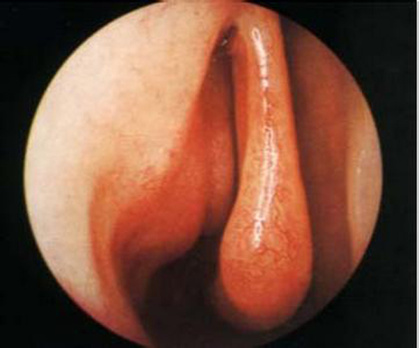 早期鼻竇單純性慢性鼻炎