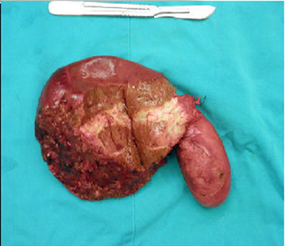 肝內膽管癌的症狀