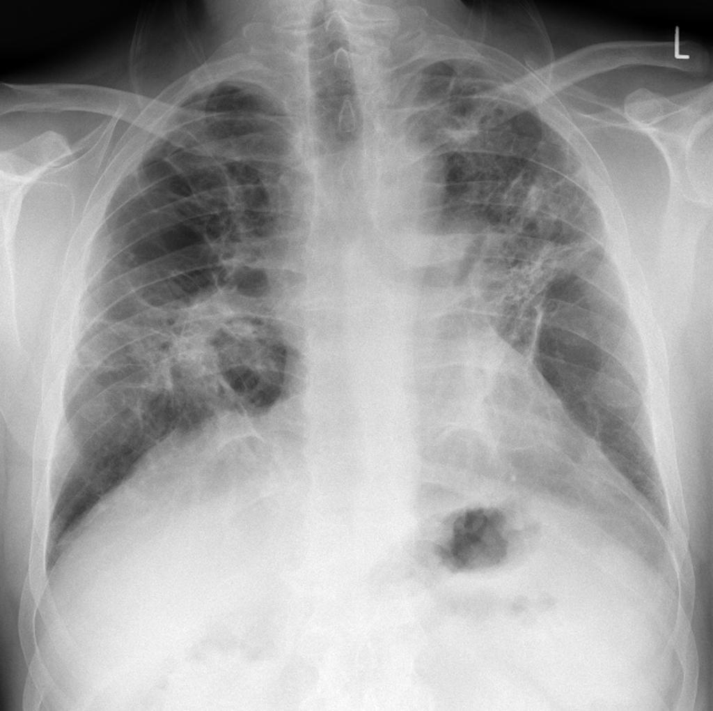 ＿中期肺纖維化X光