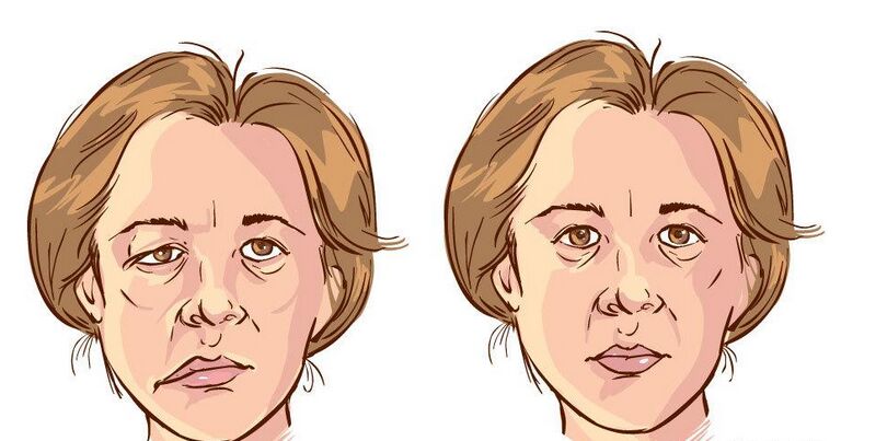 女人面癱的症狀及表象 